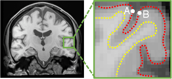 Figure 1 for Learnable Pooling in Graph Convolution Networks for Brain Surface Analysis