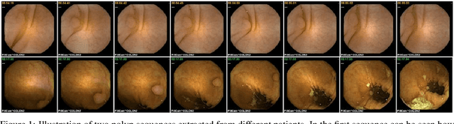 Figure 1 for WCE Polyp Detection with Triplet based Embeddings