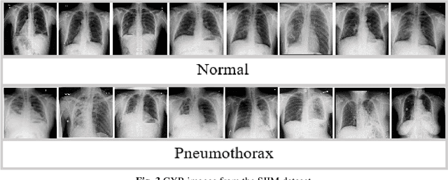 Figure 4 for A Hybrid VDV Model for Automatic Diagnosis of Pneumothorax using Class-Imbalanced Chest X-rays Dataset