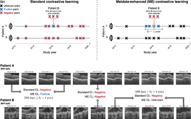 Figure 3 for Metadata-enhanced contrastive learning from retinal optical coherence tomography images