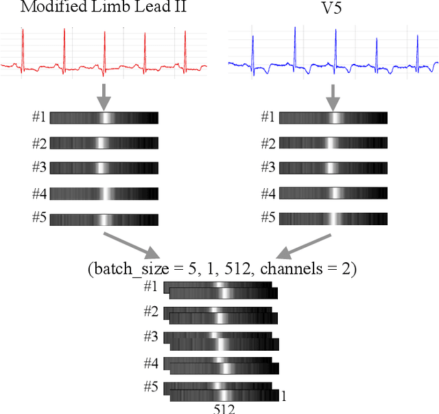 Figure 2 for Multi-Lead ECG Classification via an Information-Based Attention Convolutional Neural Network