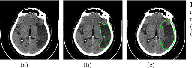 Figure 1 for Weakly supervised semantic segmentation of tomographic images in the diagnosis of stroke