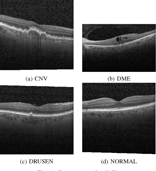 Figure 1 for A Comparison of Handcrafted and Deep Neural Network Feature Extraction for Classifying Optical Coherence Tomography Images