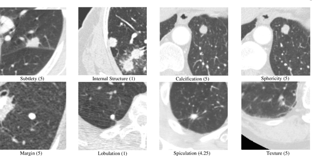 Figure 1 for Diagnose Like a Radiologist: Hybrid Neuro-Probabilistic Reasoning for Attribute-Based Medical Image Diagnosis