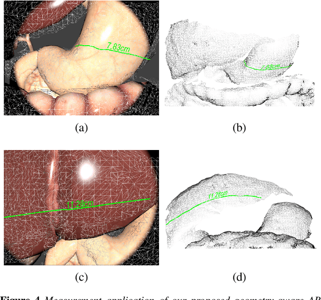 Figure 4 for Real-time Geometry-Aware Augmented Reality in Minimally Invasive Surgery