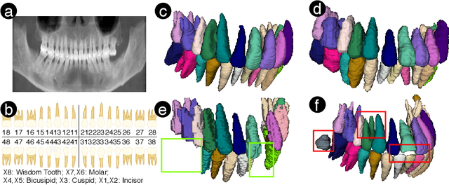 Figure 4 for X2Teeth: 3D Teeth Reconstruction from a Single Panoramic Radiograph