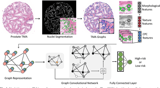 Figure 1 for Weakly Supervised Prostate TMA Classification via Graph Convolutional Networks