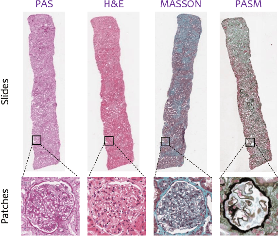Figure 1 for G2C: A Generator-to-Classifier Framework Integrating Multi-Stained Visual Cues for Pathological Glomerulus Classification