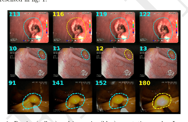 Figure 1 for ERS: a novel comprehensive endoscopy image dataset for machine learning, compliant with the MST 3.0 specification