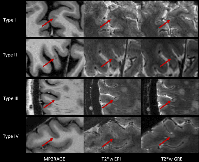 Figure 1 for Automated Detection of Cortical Lesions in Multiple Sclerosis Patients with 7T MRI