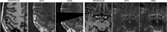 Figure 3 for Automated Detection of Cortical Lesions in Multiple Sclerosis Patients with 7T MRI