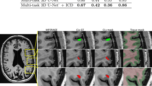 Figure 4 for Automated Detection of Cortical Lesions in Multiple Sclerosis Patients with 7T MRI