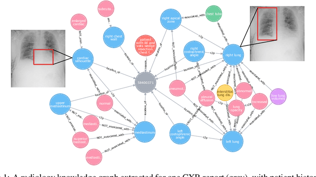 Figure 2 for Chest ImaGenome Dataset for Clinical Reasoning