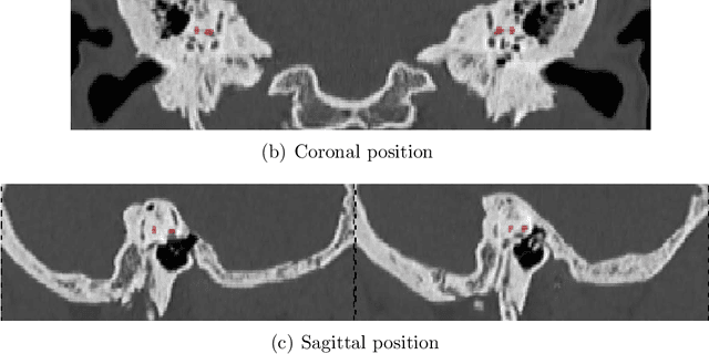 Figure 3 for A lateral semicircular canal segmentation based geometric calibration for human temporal bone CT Image