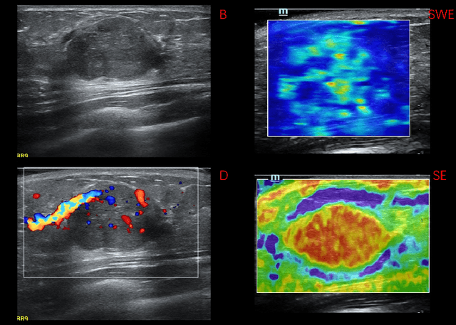 Figure 1 for Auto-weighting for Breast Cancer Classification in Multimodal Ultrasound