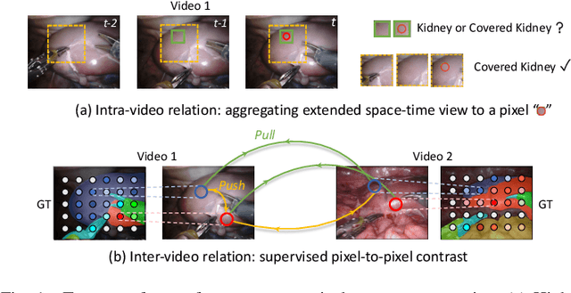 Figure 1 for Exploring Intra- and Inter-Video Relation for Surgical Semantic Scene Segmentation