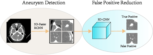 Figure 1 for Deep Learning Based Detection and Localization of Cerebal Aneurysms in Computed Tomography Angiography