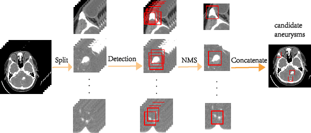 Figure 3 for Deep Learning Based Detection and Localization of Cerebal Aneurysms in Computed Tomography Angiography