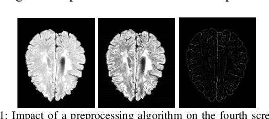 Figure 1 for Multiple Sclerosis Lesions Segmentation using Attention-Based CNNs in FLAIR Images