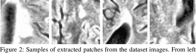 Figure 3 for Multiple Sclerosis Lesions Segmentation using Attention-Based CNNs in FLAIR Images