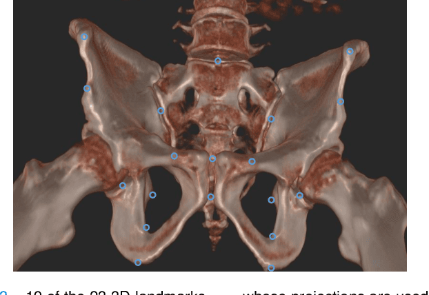 Figure 3 for Pose-dependent weights and Domain Randomization for fully automatic X-ray to CT Registration