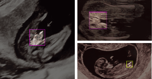 Figure 2 for A Deep Learning Approach for Masking Fetal Gender in Ultrasound Images