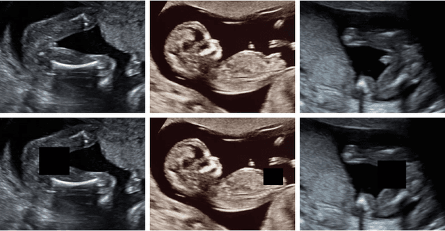 Figure 4 for A Deep Learning Approach for Masking Fetal Gender in Ultrasound Images