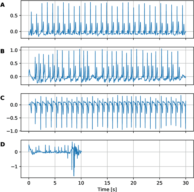 Figure 3 for Cardiac Arrhythmia Detection from ECG with Convolutional Recurrent Neural Networks
