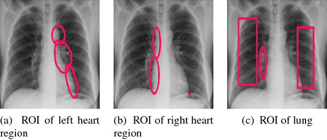 Figure 1 for Deep Mask For X-ray Based Heart Disease Classification