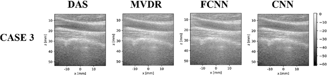 Figure 4 for Towards Fast Region Adaptive Ultrasound Beamformer for Plane Wave Imaging Using Convolutional Neural Networks