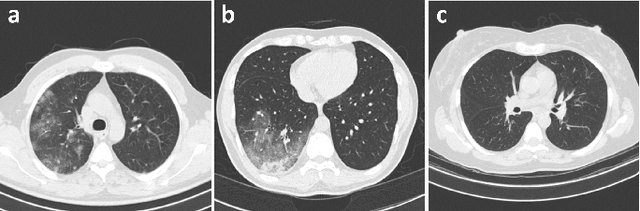 Figure 1 for COVIDx CT-3: A Large-scale, Multinational, Open-Source Benchmark Dataset for Computer-aided COVID-19 Screening from Chest CT Images