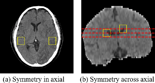 Figure 1 for Symmetry-Enhanced Attention Network for Acute Ischemic Infarct Segmentation with Non-Contrast CT Images
