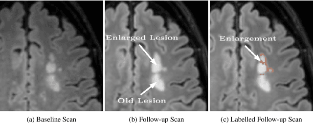 Figure 1 for Multiple Sclerosis Lesion Activity Segmentation with Attention-Guided Two-Path CNNs