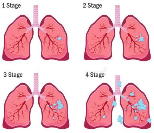 Figure 1 for Deep fusion of gray level co-occurrence matrices for lung nodule classification