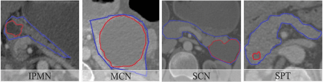 Figure 1 for Differential Diagnosis for Pancreatic Cysts in CT Scans Using Densely-Connected Convolutional Networks