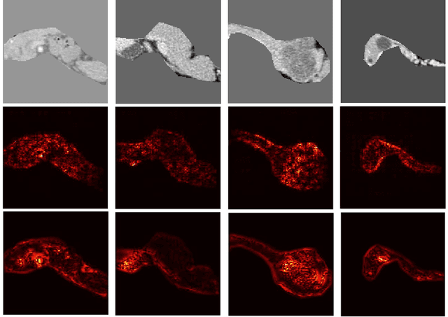 Figure 4 for Differential Diagnosis for Pancreatic Cysts in CT Scans Using Densely-Connected Convolutional Networks