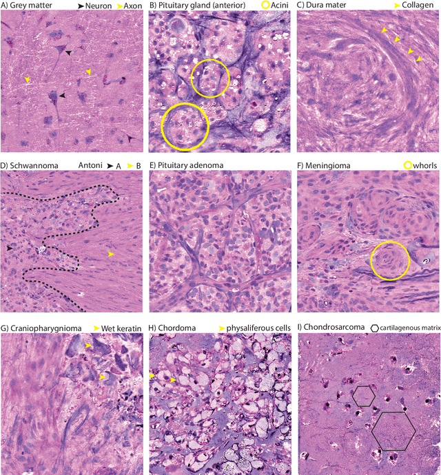 Figure 3 for Contrastive Representation Learning for Rapid Intraoperative Diagnosis of Skull Base Tumors Imaged Using Stimulated Raman Histology