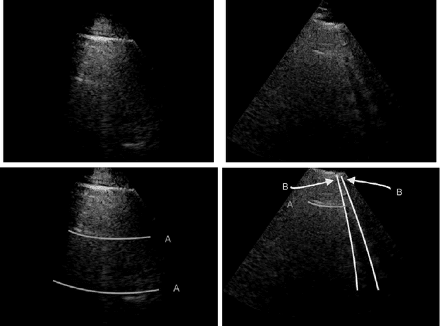 Figure 1 for Line Artefact Quantification in Lung Ultrasound Images of COVID-19 Patients via Non-Convex Regularisation