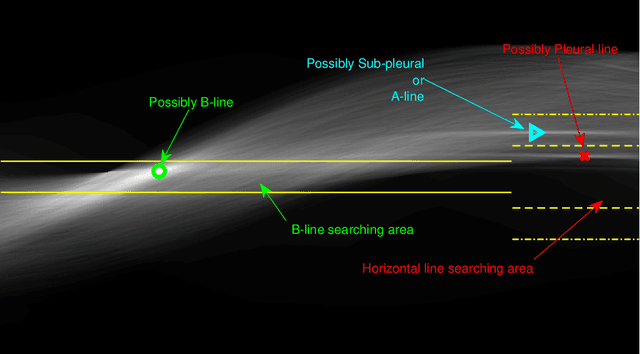 Figure 4 for Line Artefact Quantification in Lung Ultrasound Images of COVID-19 Patients via Non-Convex Regularisation