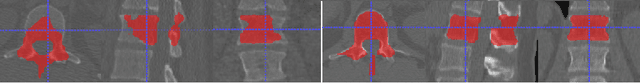 Figure 4 for Accurately identifying vertebral levels in large datasets