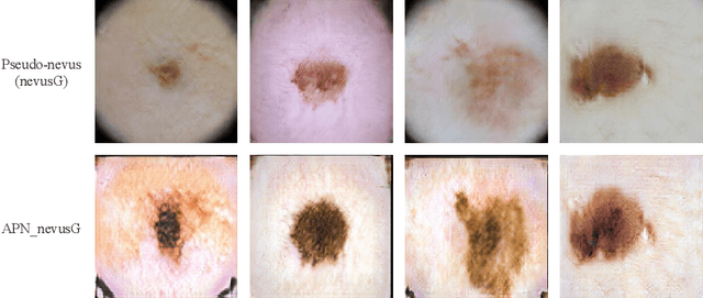 Figure 2 for Bulk Production Augmentation Towards Explainable Melanoma Diagnosis