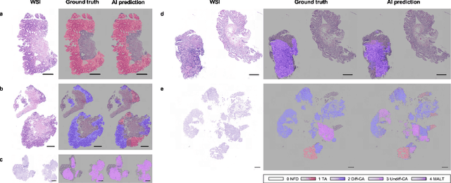 Figure 3 for A hybrid 2-stage vision transformer for AI-assisted 5 class pathologic diagnosis of gastric endoscopic biopsies