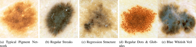Figure 1 for On Interpretability of Deep Learning based Skin Lesion Classifiers using Concept Activation Vectors