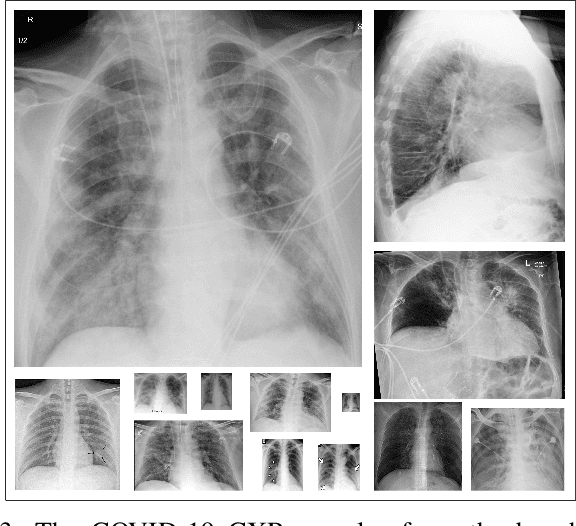 Figure 3 for COVID-19 Infection Map Generation and Detection from Chest X-Ray Images