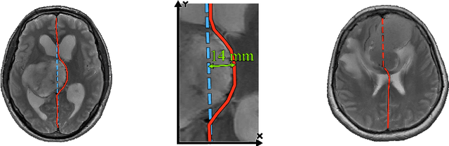 Figure 1 for Incorporating Task-Specific Structural Knowledge into CNNs for Brain Midline Shift Detection