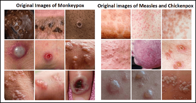 Figure 3 for Monkeypox Skin Lesion Detection Using Deep Learning Models: A Feasibility Study