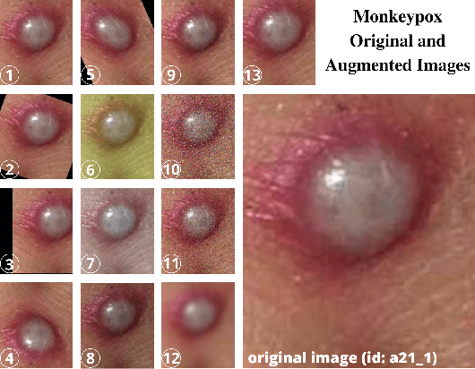 Figure 4 for Monkeypox Skin Lesion Detection Using Deep Learning Models: A Feasibility Study