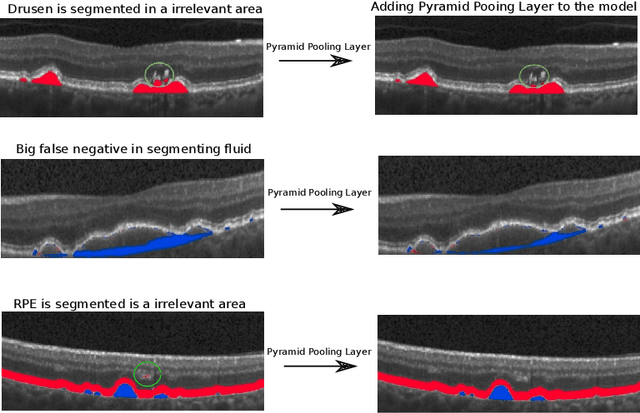 Figure 4 for U-Net with spatial pyramid pooling for drusen segmentation in optical coherence tomography