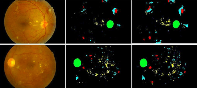 Figure 3 for Fully Convolutional Neural Network for Semantic Segmentation of Anatomical Structure and Pathologies in Colour Fundus Images Associated with Diabetic Retinopathy