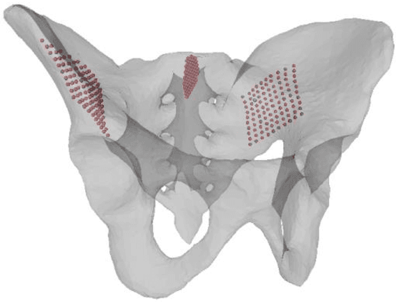 Figure 2 for An Internal Arc Fixation Channel and Automatic Planning Algorithm for Pelvic Fracture